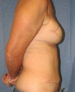 Breast Reconstruction