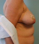 Breast Reconstruction