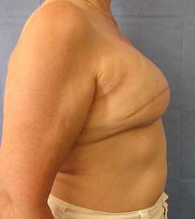 Breast Reconstruction