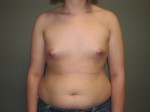 Breast Reconstruction