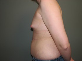 Breast Reconstruction