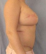 Breast Reconstruction