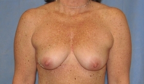 Breast Reconstruction