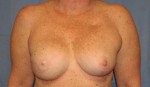 Breast Reconstruction