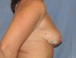 Breast Reconstruction