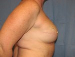 Breast Reconstruction