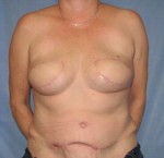 Breast Reconstruction