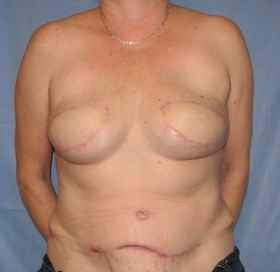 Breast Reconstruction