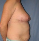 Breast Reconstruction