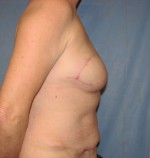 Breast Reconstruction