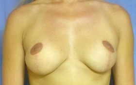 Breast Reconstruction