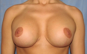 Breast Reconstruction