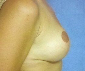 Breast Reconstruction