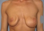 Breast Augmentation Revision