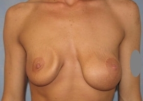 Breast Augmentation Revision