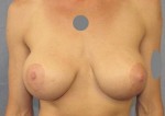 Breast Augmentation Revision