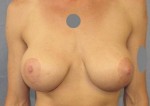 Breast Reconstruction