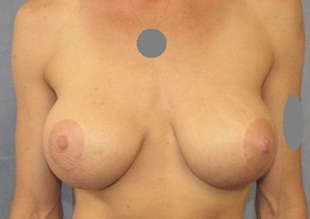 Breast Augmentation Revision