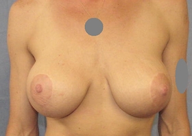 Breast Reconstruction