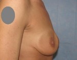 Breast Augmentation Revision