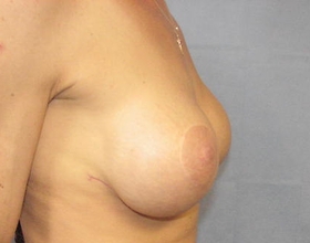 Breast Augmentation Revision