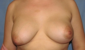 Breast Reconstruction