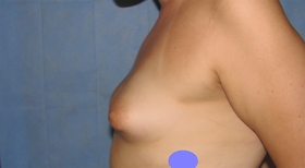 Breast Reconstruction