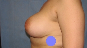 Breast Reconstruction