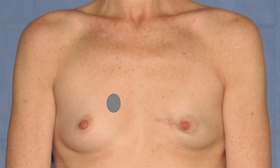 Breast Reconstruction