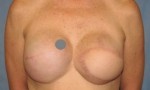 Breast Reconstruction