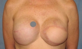 Breast Reconstruction