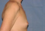 Breast Reconstruction