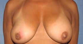 Breast Reconstruction