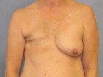 Breast Reconstruction