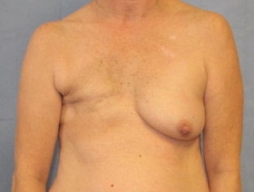 Breast Reconstruction