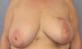 Breast Reconstruction