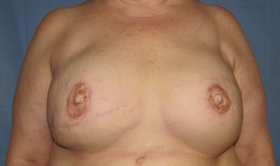 Breast Reconstruction