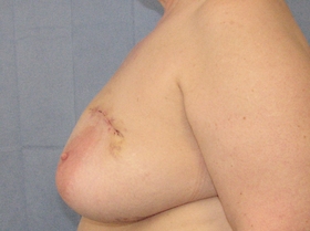 Breast Reconstruction