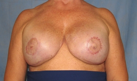 Breast Reconstruction