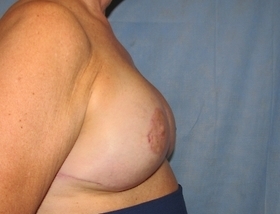 Breast Reconstruction