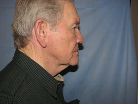 Facelift & Necklift