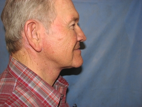 Facelift & Necklift