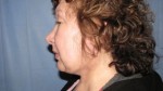 Facelift & Necklift