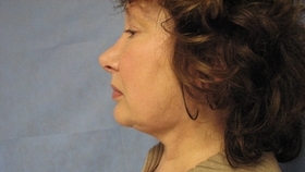 Facelift & Necklift