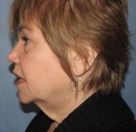 Facelift & Necklift