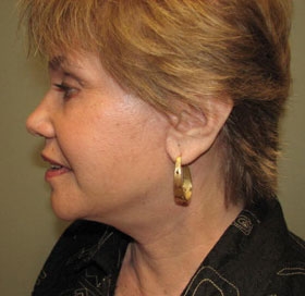 Facelift & Necklift