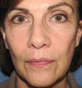 Facelift & Necklift