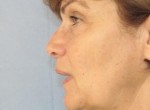 Facelift & Necklift