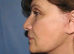 Facelift & Necklift