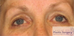 Blepharoplasty